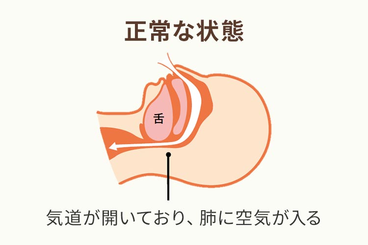 睡眠時無呼吸症候群の原因は?