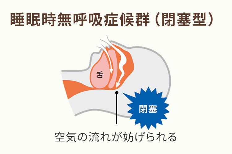 睡眠時無呼吸症候群の原因は?