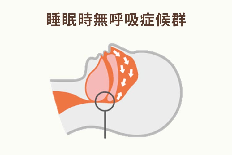 CPAPってどんな治療なの？